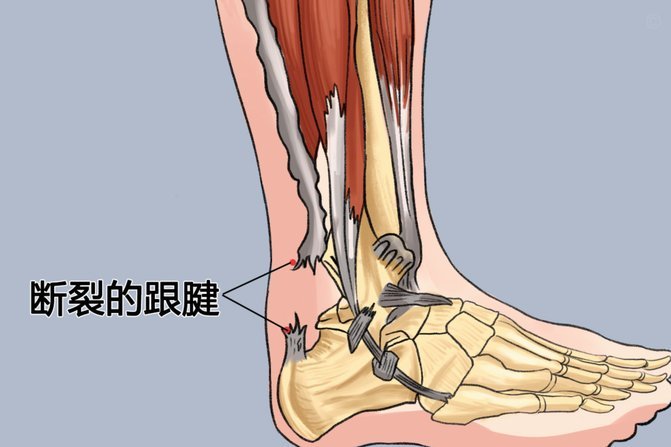 上海申花官方：盖伊左脚跟腱断裂 需尽快进行手术治疗