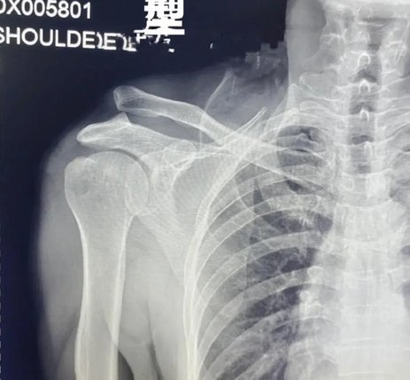 海牛官方：图费格季奇右肩锁关节完全脱位，预计伤缺5-7周